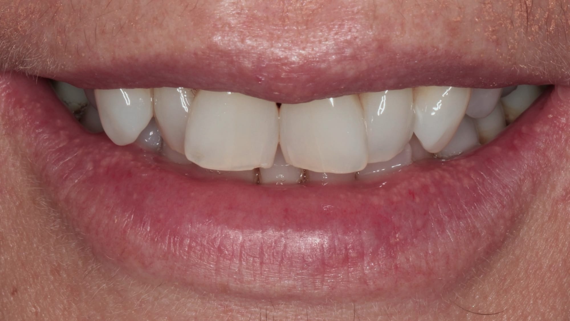 Before — Rotations — twisted teeth refined back into line