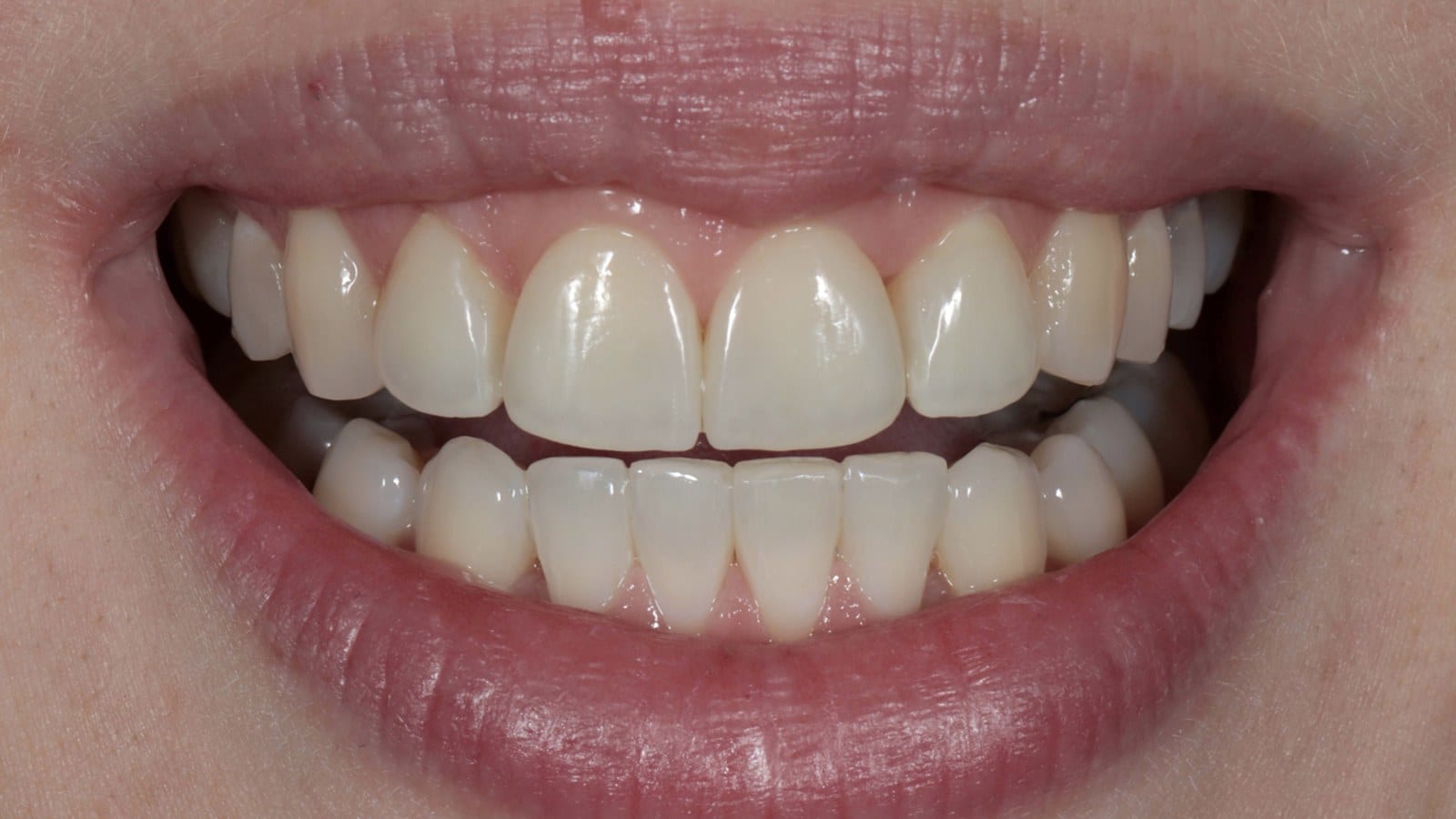 After — Rotations — twisted teeth turned back into line
