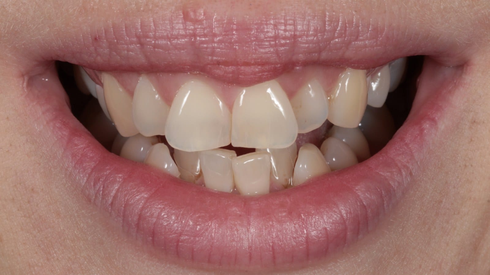 Before — Rotations — twisted teeth turned back into line