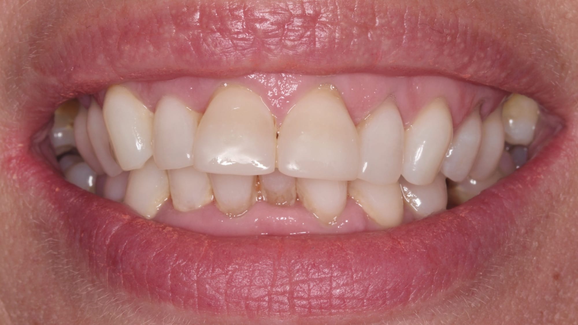 Before — Severe crowding correction