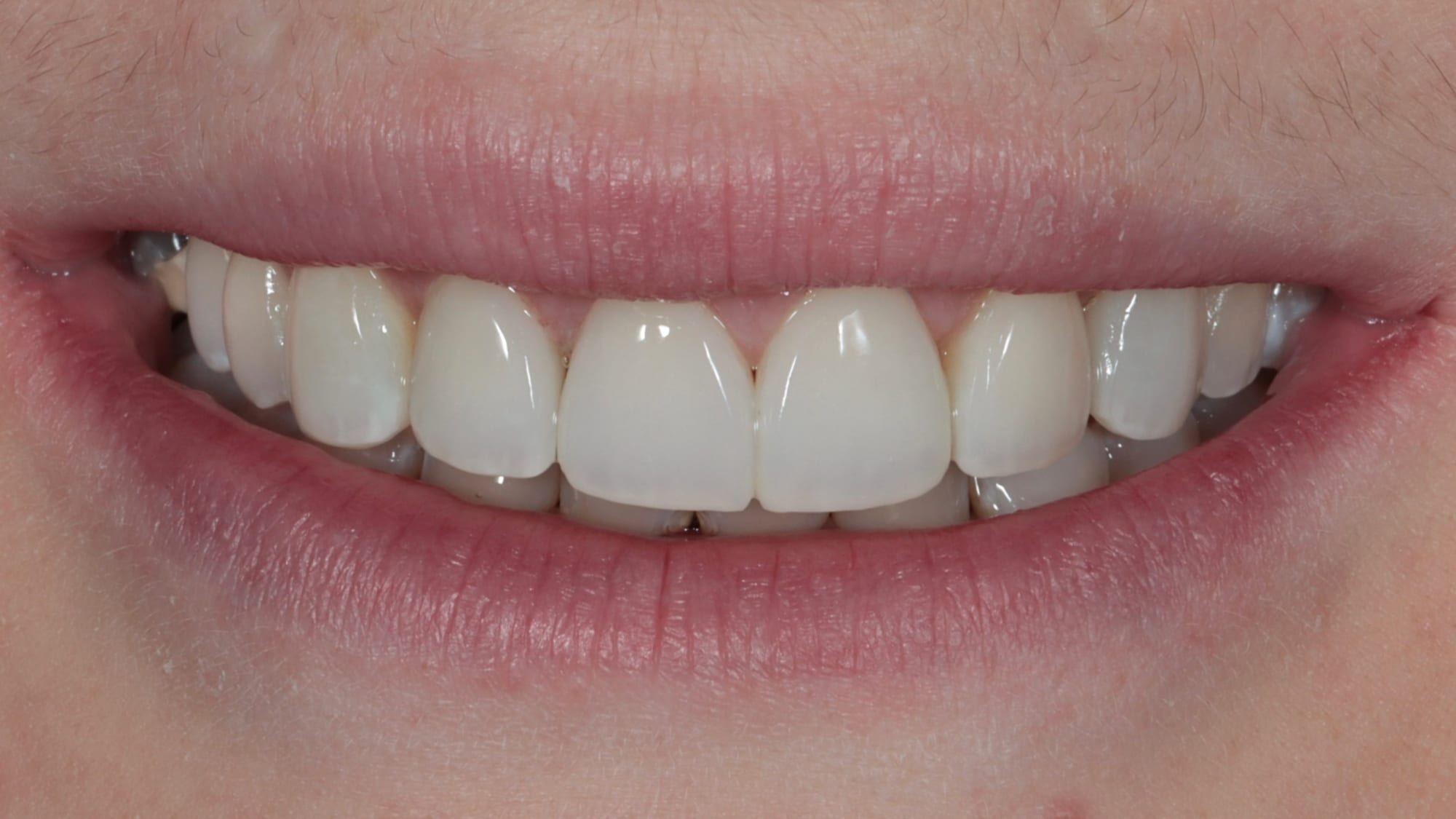 After — Invisalign and 6x natural composite veneers — severe crowding, missing tooth and tooth wear