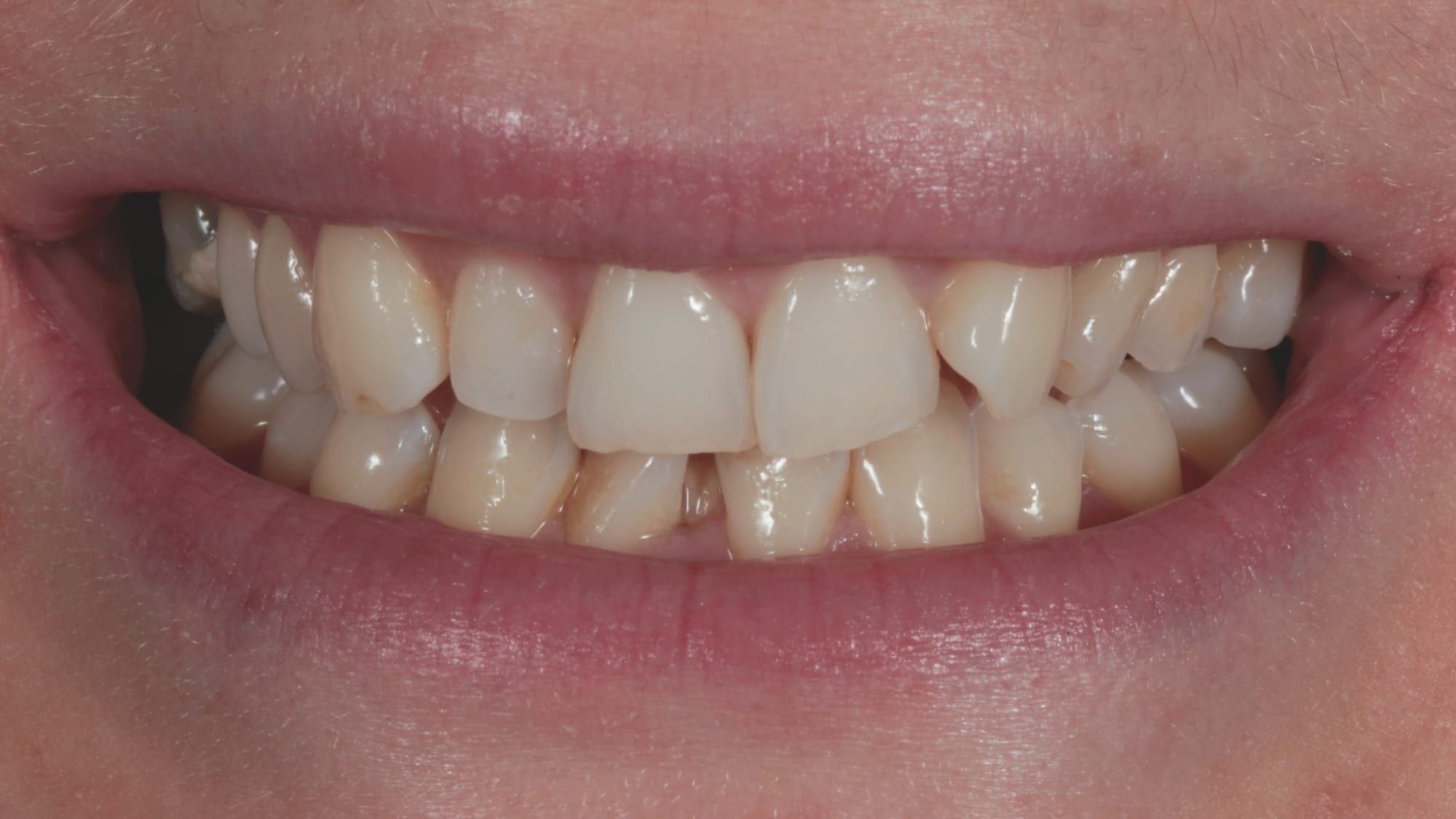 Before — Invisalign and 6x natural composite veneers — severe crowding, missing tooth and tooth wear