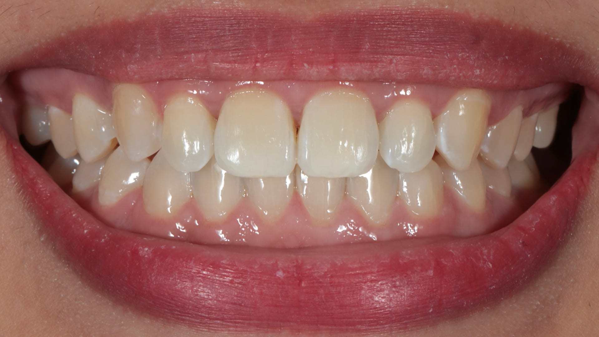 After — Underbite — repositioned for a balanced bite