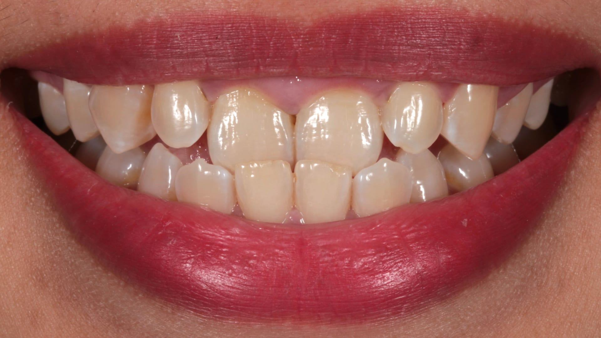 Before — Underbite — repositioned for a balanced bite
