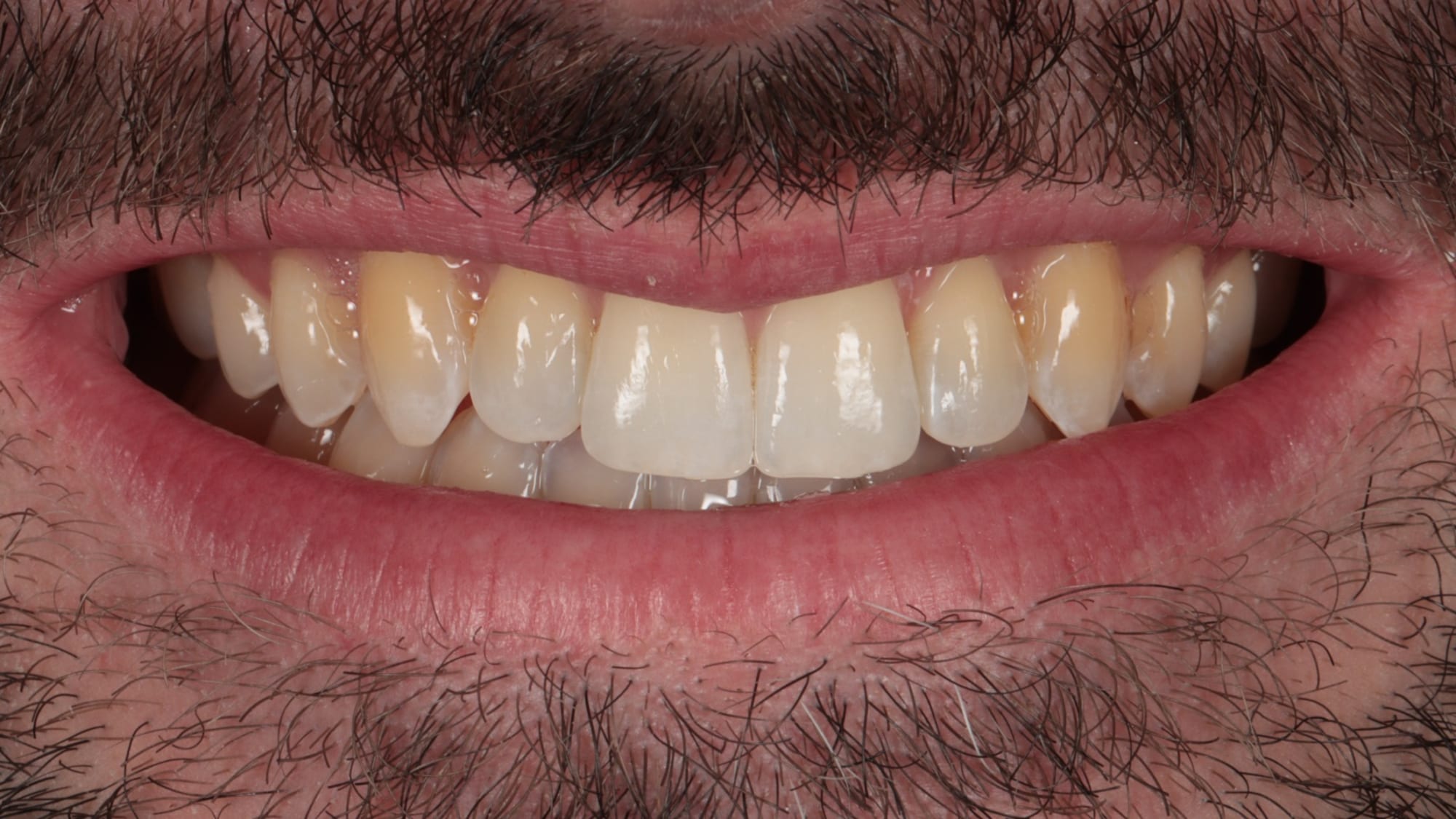 After — Underbite correction — Invisalign