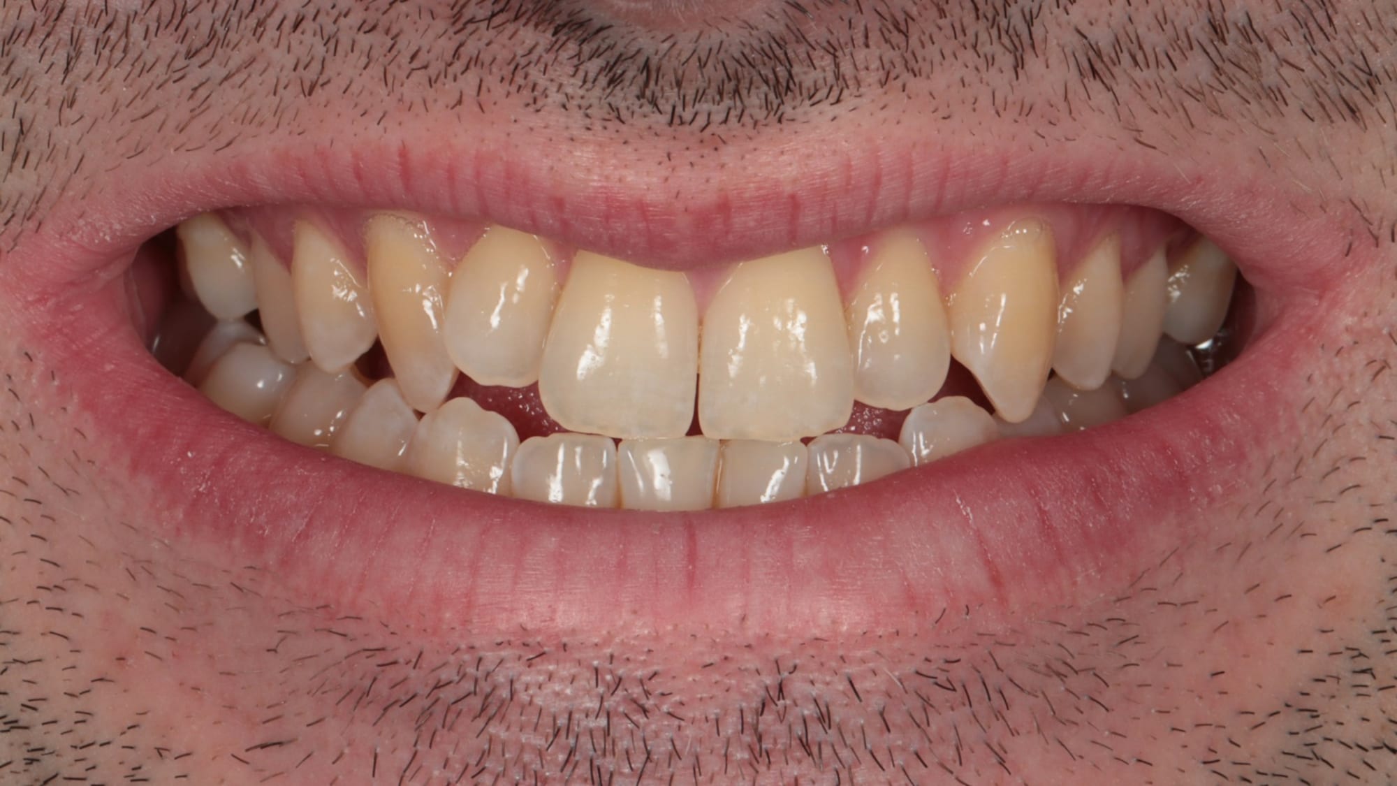 Before — Underbite correction — Invisalign