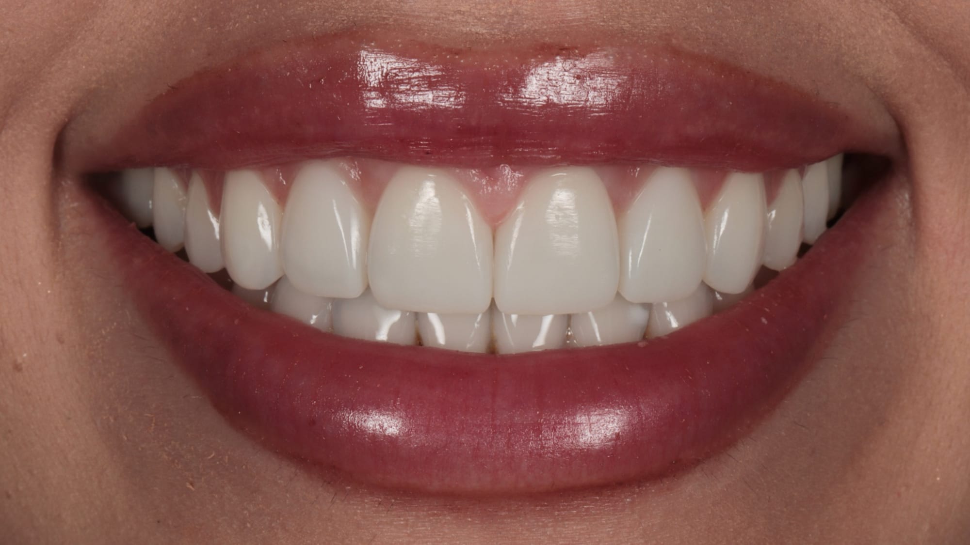 After — Invisalign, 4x gum contouring and 6x Hollywood composite bonding — flared teeth and excess gum