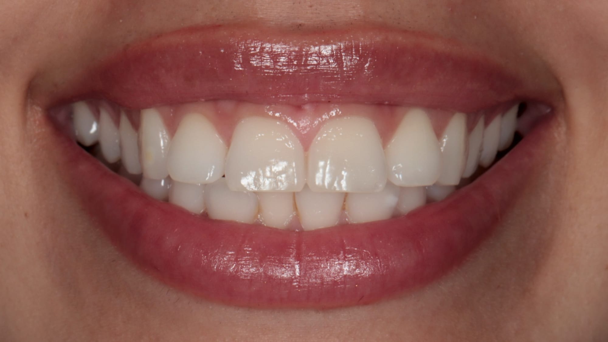 Before — Invisalign, 4x gum contouring and 6x Hollywood composite bonding — flared teeth and excess gum