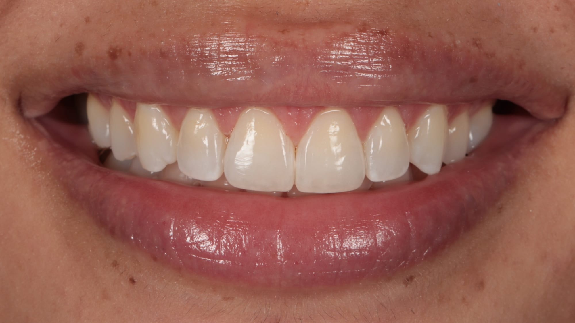 After — 4x gum contouring and 2x natural composite bonding