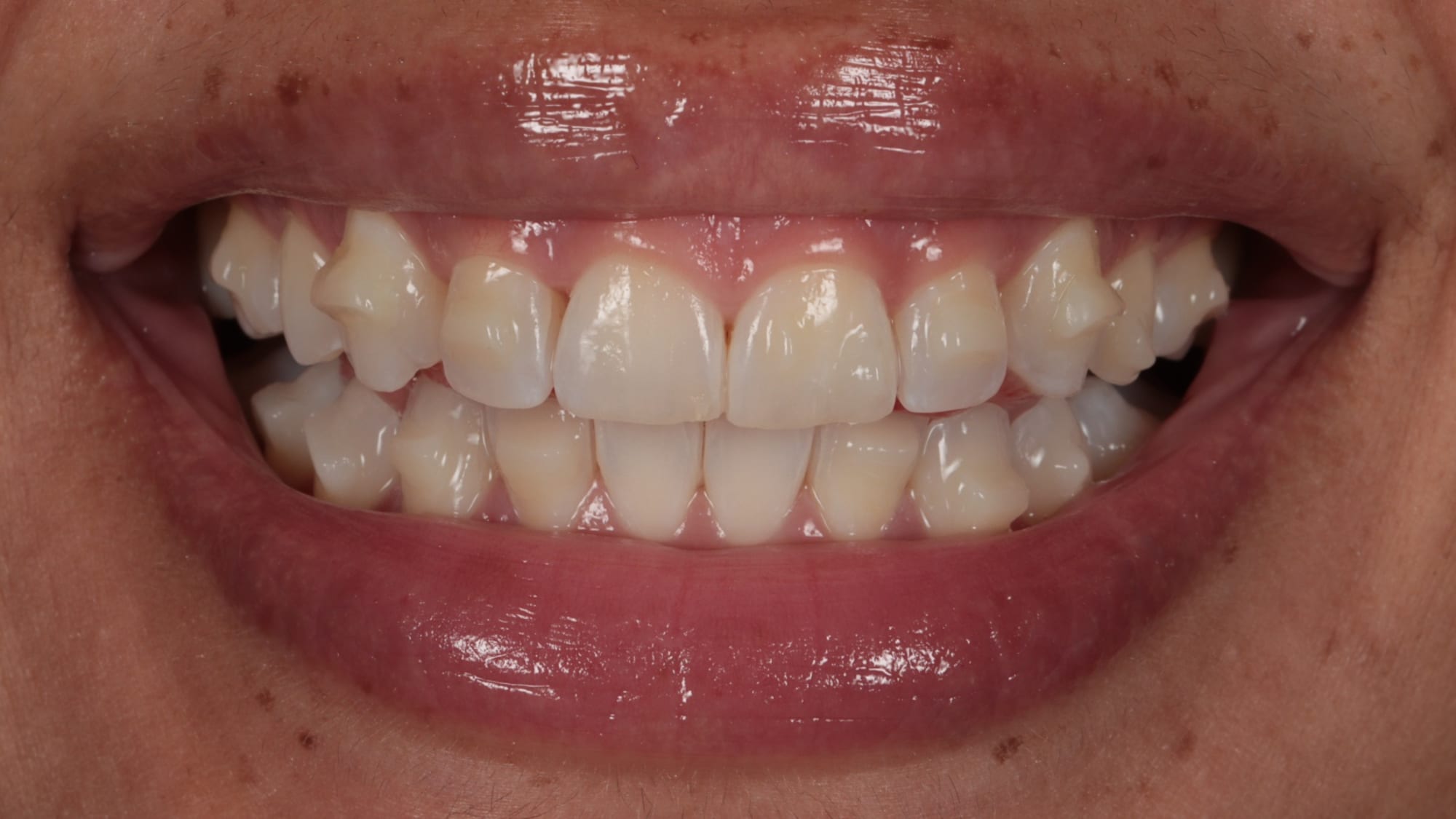 Before — 4x gum contouring and 2x natural composite bonding