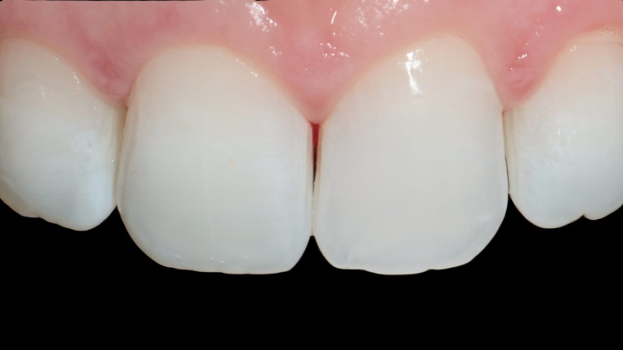 After — ICON white spot treatment — resin infiltration