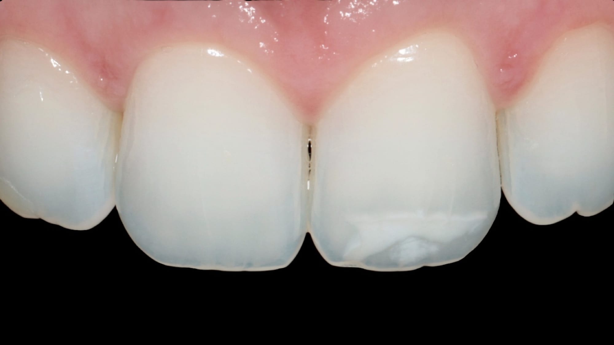 Before — ICON white spot treatment — resin infiltration