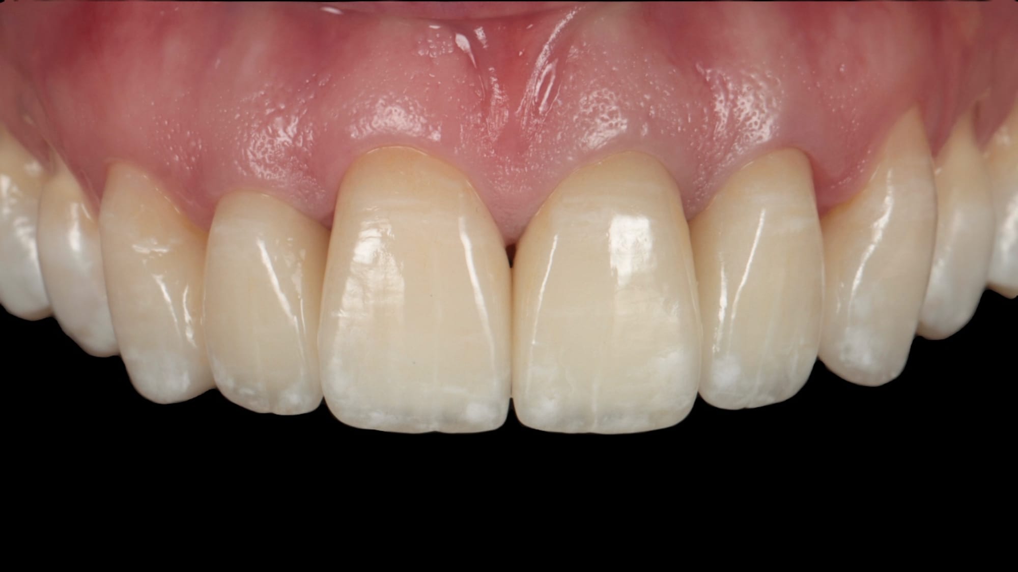 After — Hand-layered porcelain — a natural, hard-wearing result