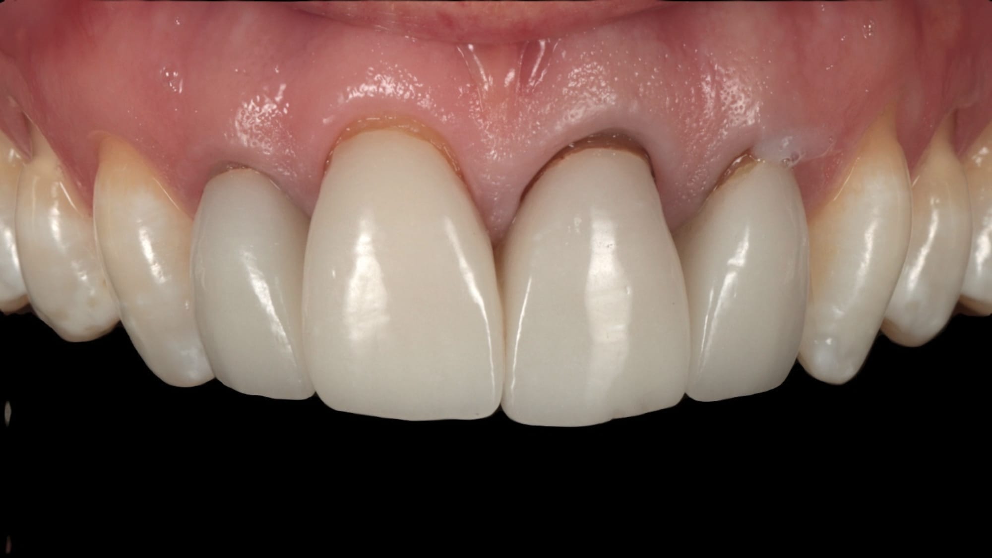 Before — Hand-layered porcelain — a natural, hard-wearing result
