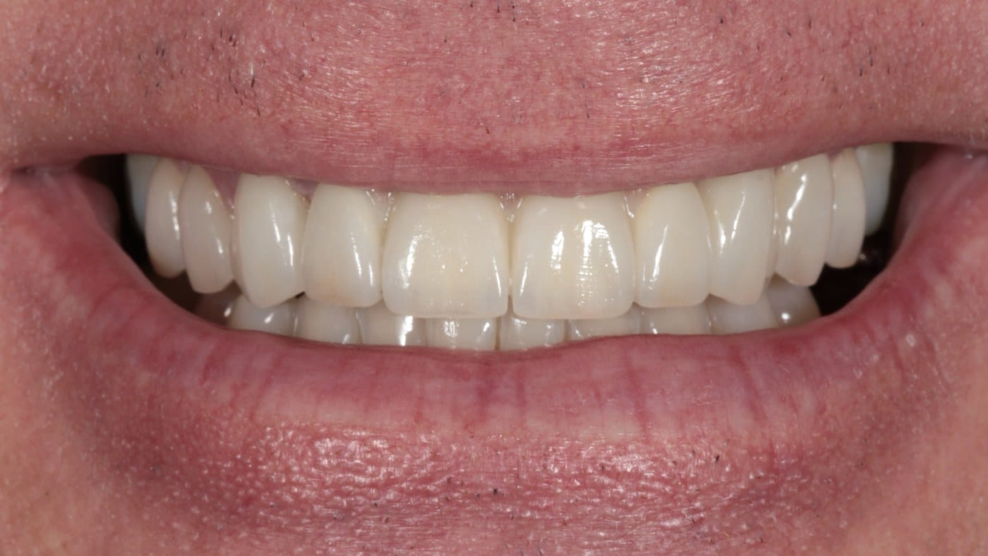 After — 4 porcelain veneers and bridge