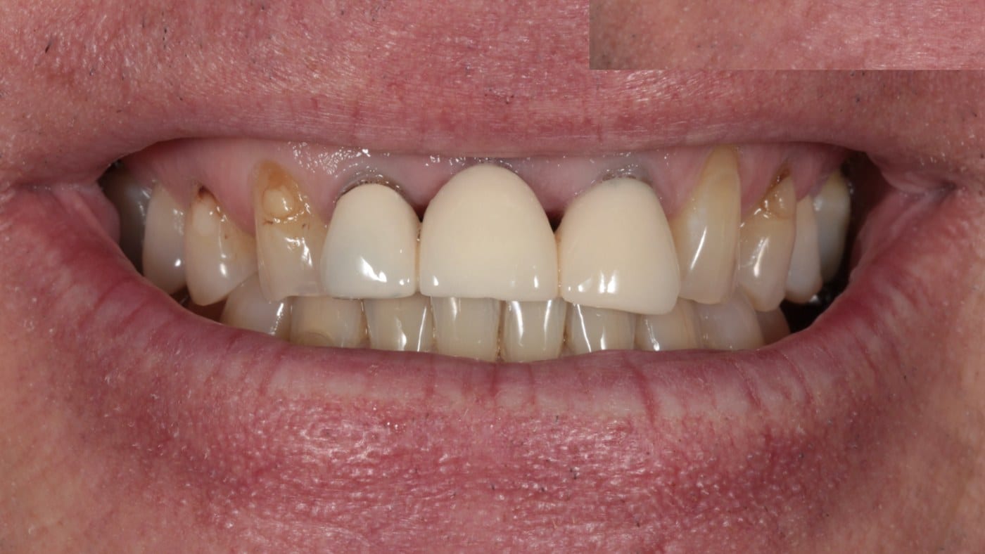 Before — 4 porcelain veneers and bridge
