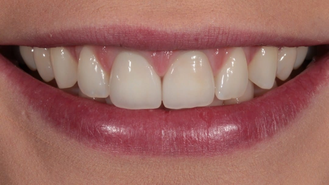 After — Discolouration corrected — 2 porcelain veneers