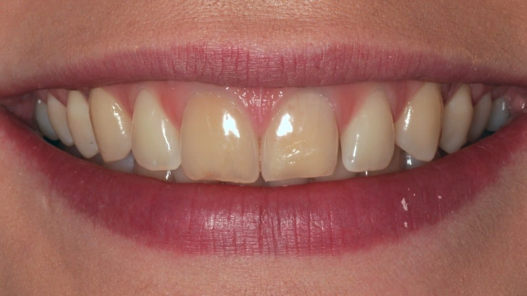 Before — Discolouration corrected — 2 porcelain veneers