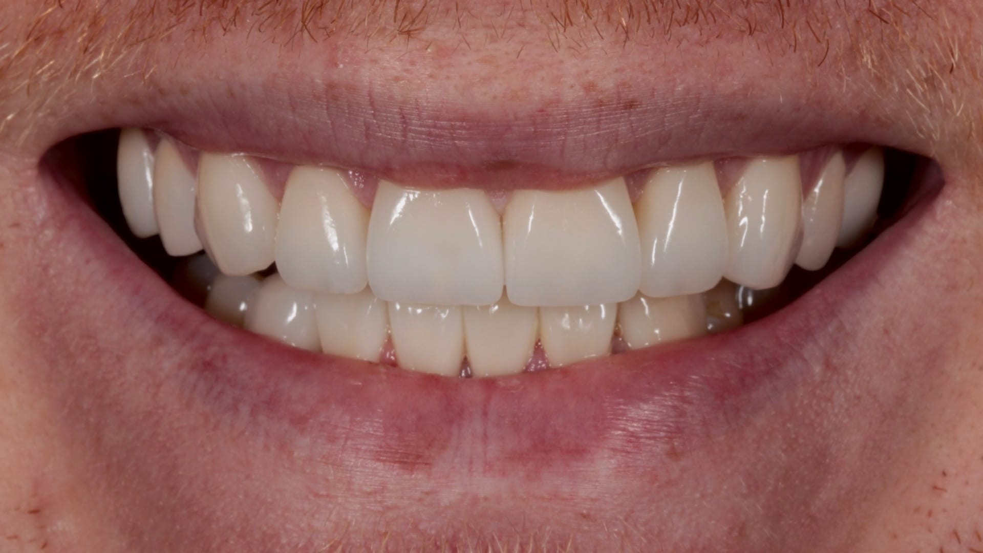 After — Discolouration and an uneven gum line corrected — 16 porcelain veneers