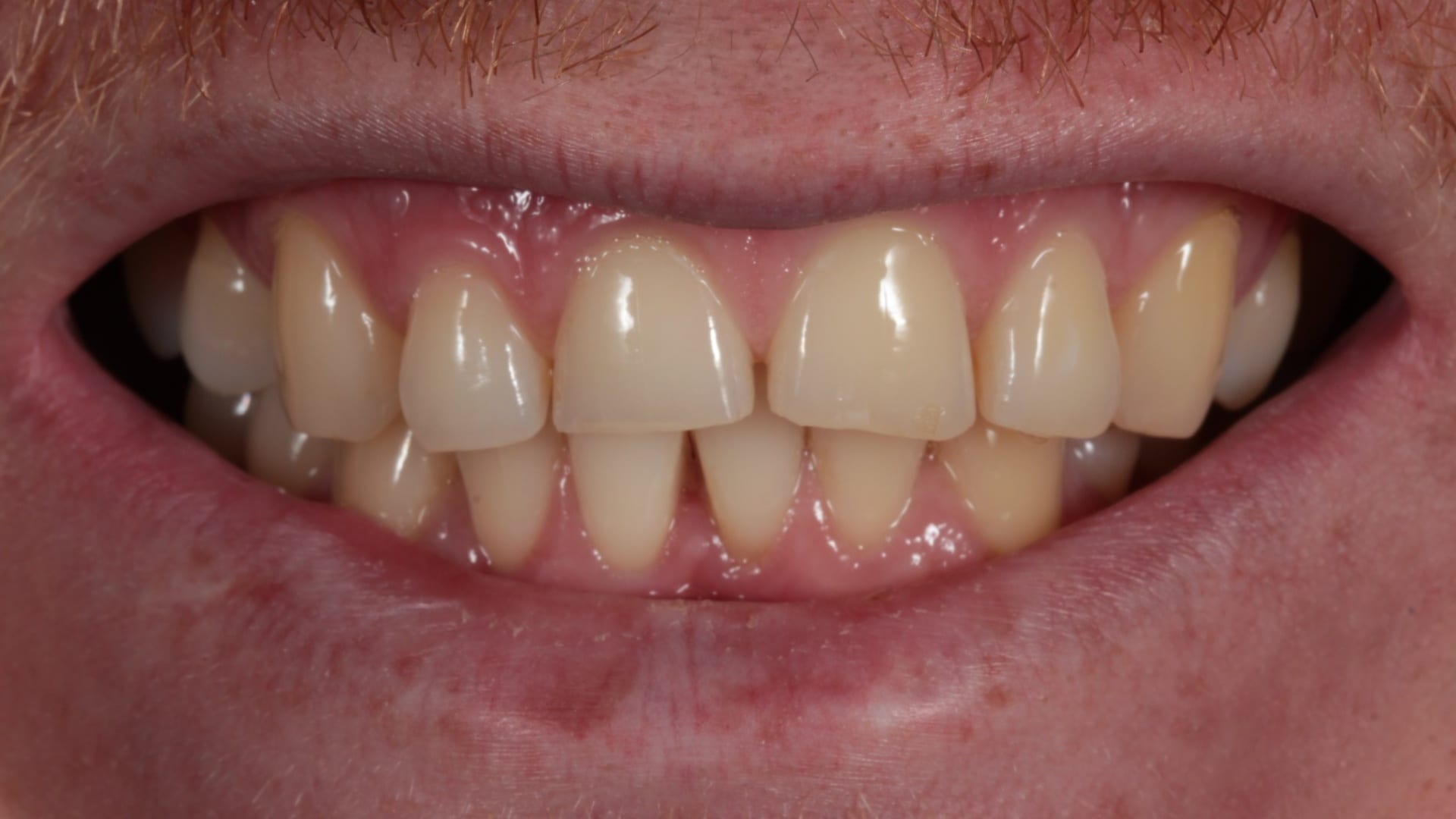 Before — Discolouration and an uneven gum line corrected — 16 porcelain veneers