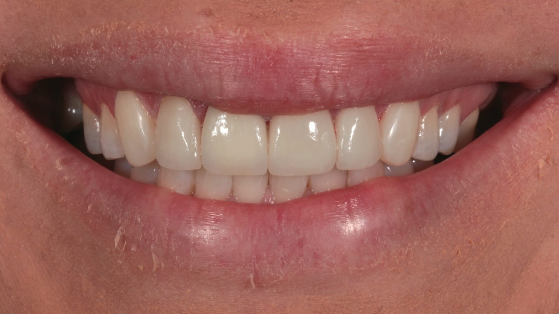After — Discolouration and wear corrected — 4 porcelain veneers
