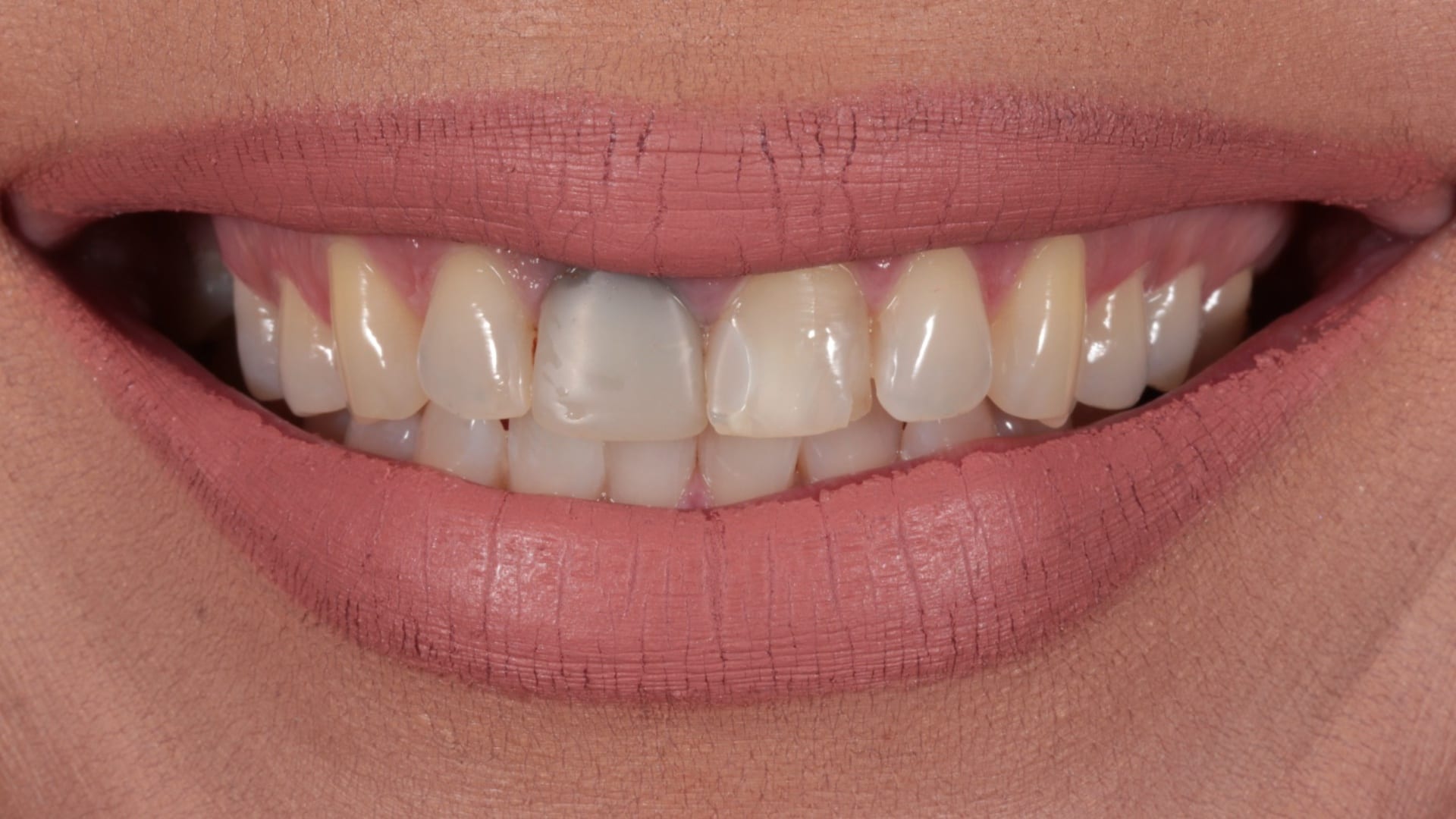 Before — Discolouration and wear corrected — 4 porcelain veneers