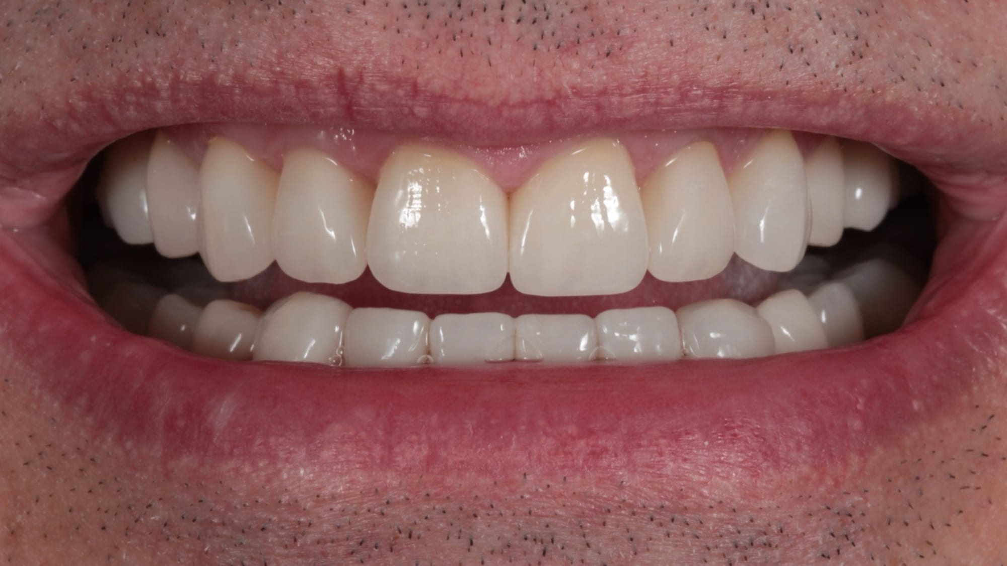 After — Full mouth rehabilitation — 24 porcelain veneers, crowns & implants