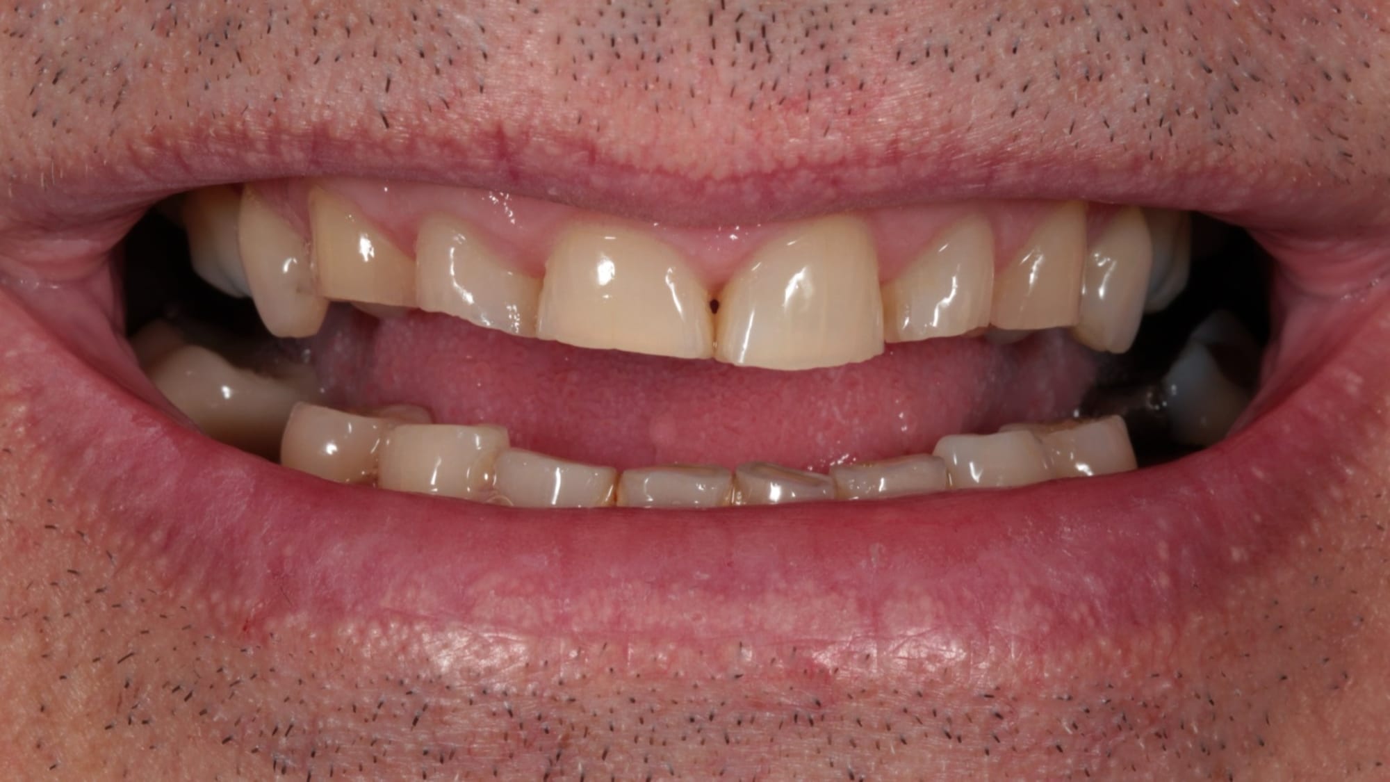 Before — Full mouth rehabilitation — 24 porcelain veneers, crowns & implants