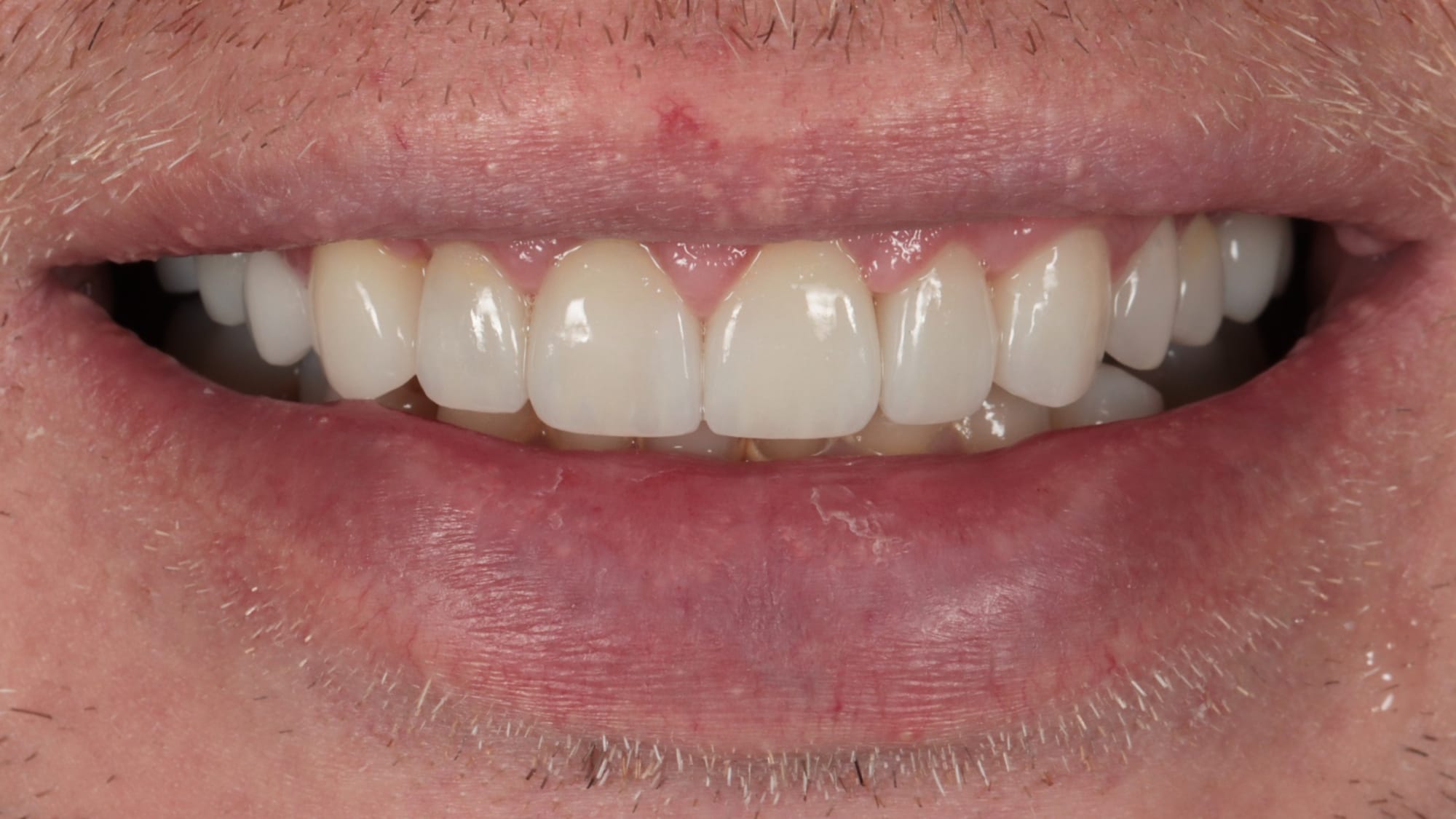 After — Gum contouring surgery, 8 porcelain veneers and 2 implants