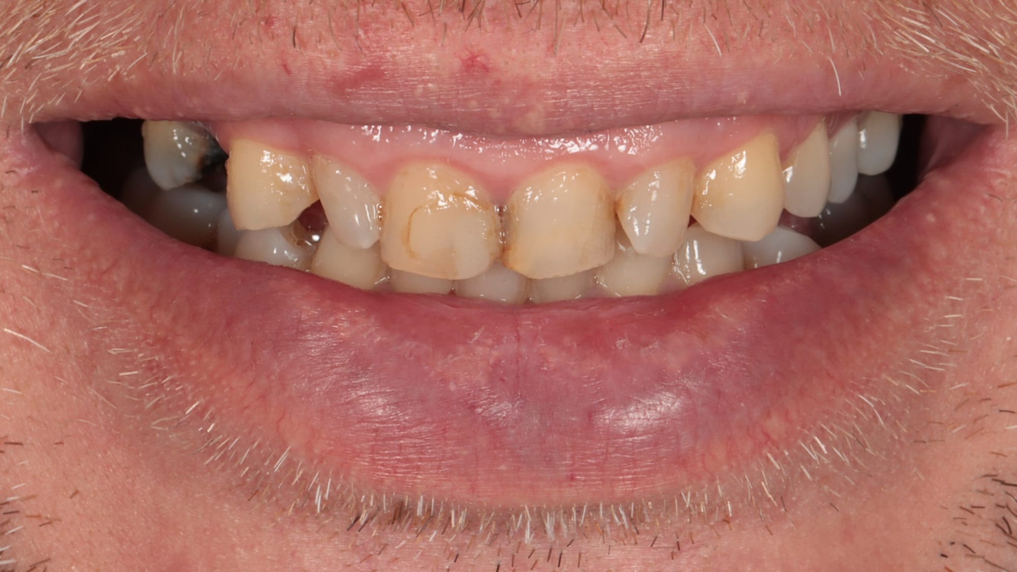Before — Gum contouring surgery, 8 porcelain veneers and 2 implants