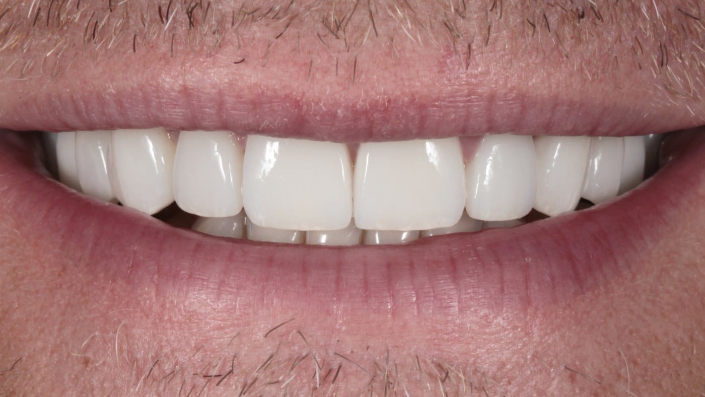 After — Hollywood porcelain veneers