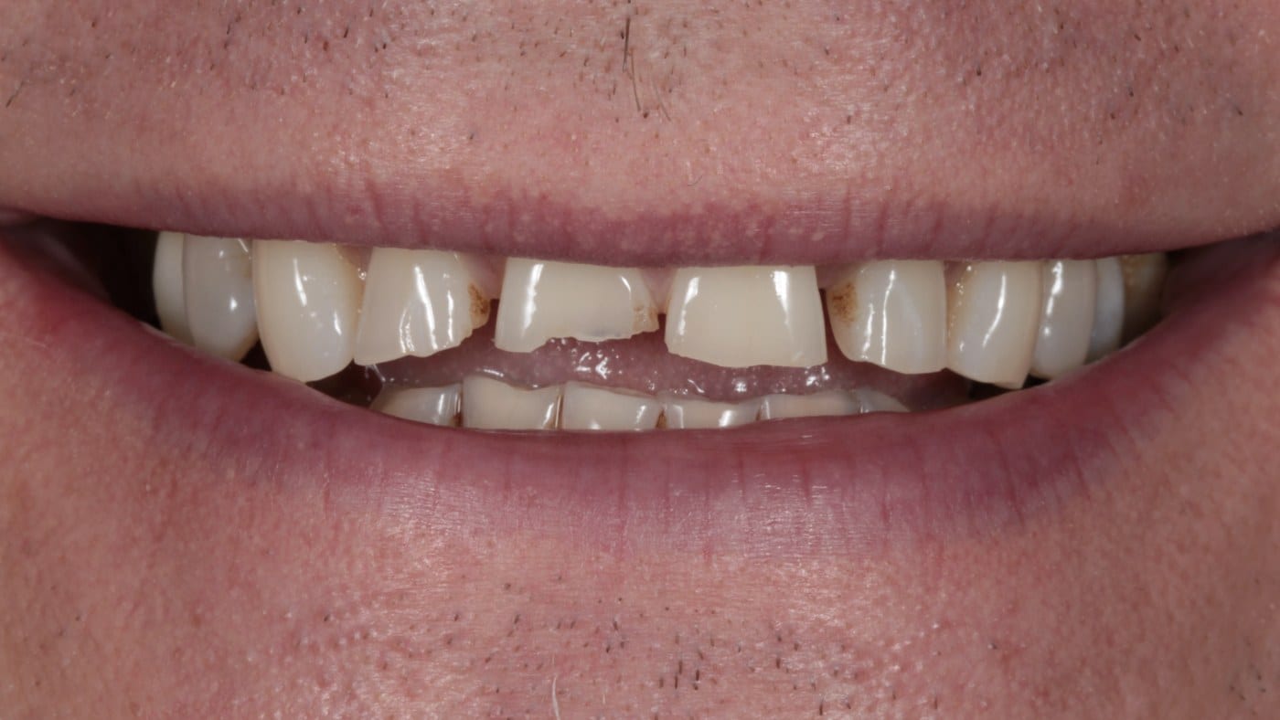 Before — Hollywood porcelain veneers