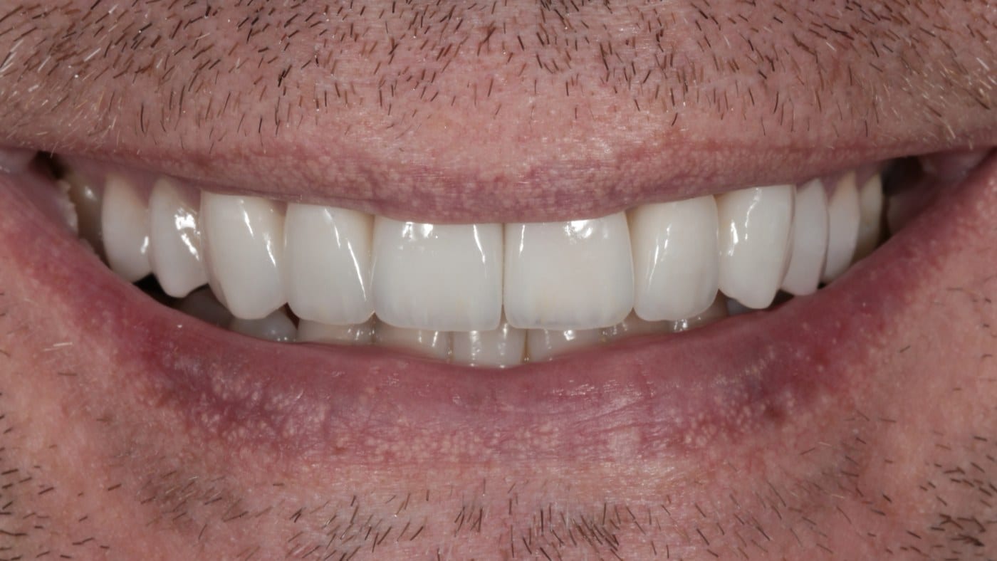 After — Invisalign and 10 porcelain veneers
