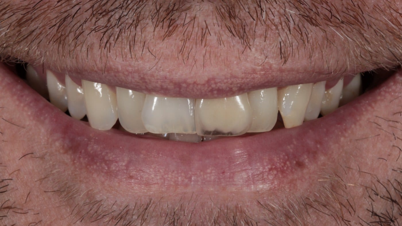Before — Invisalign and 10 porcelain veneers