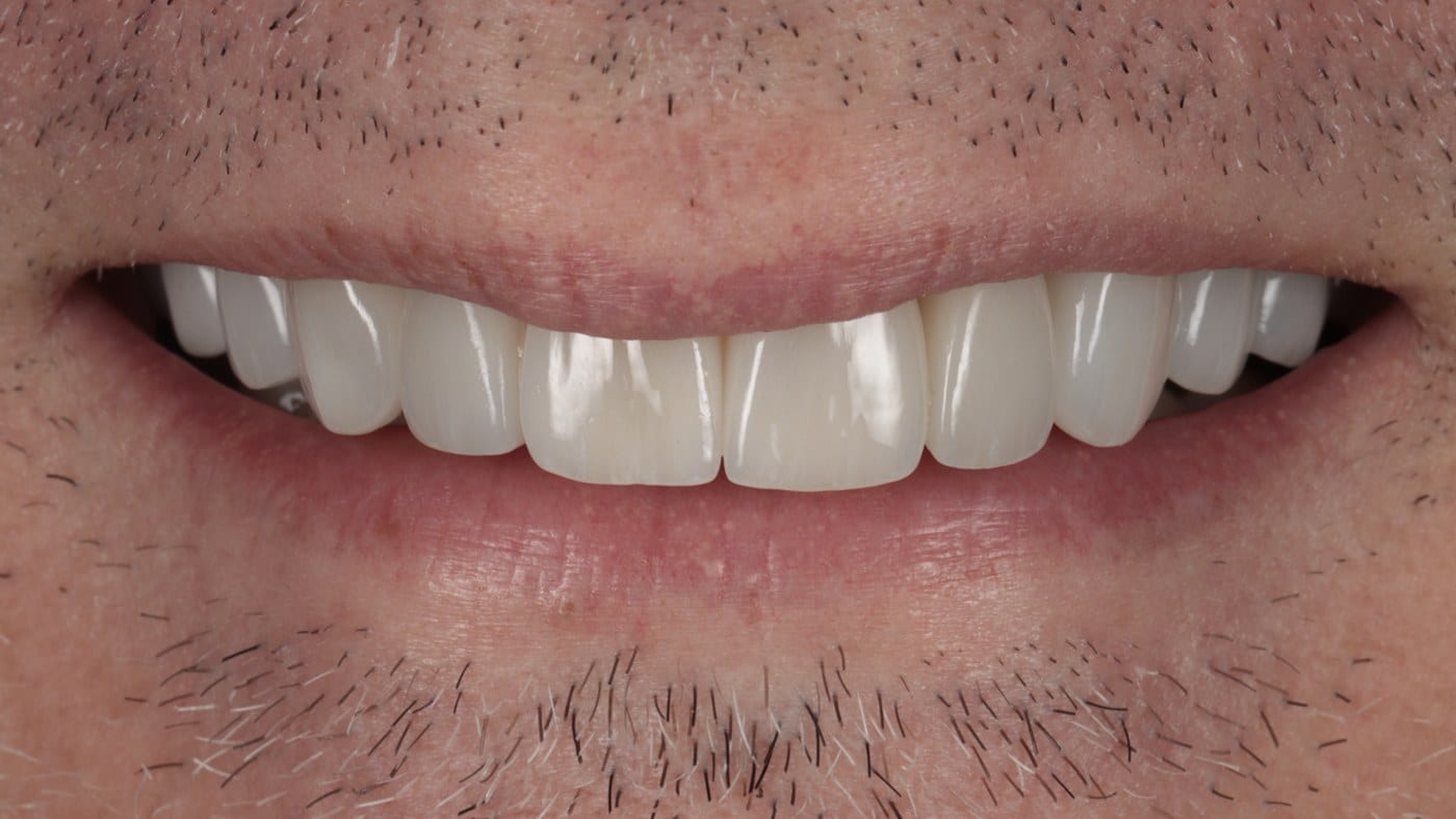 After — Invisalign and 20 porcelain veneers