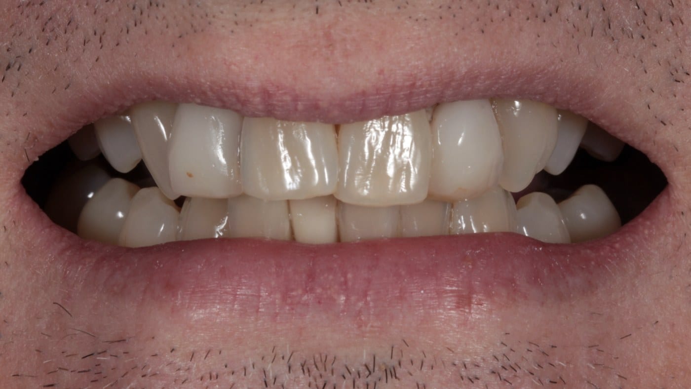 Before — Invisalign and 20 porcelain veneers