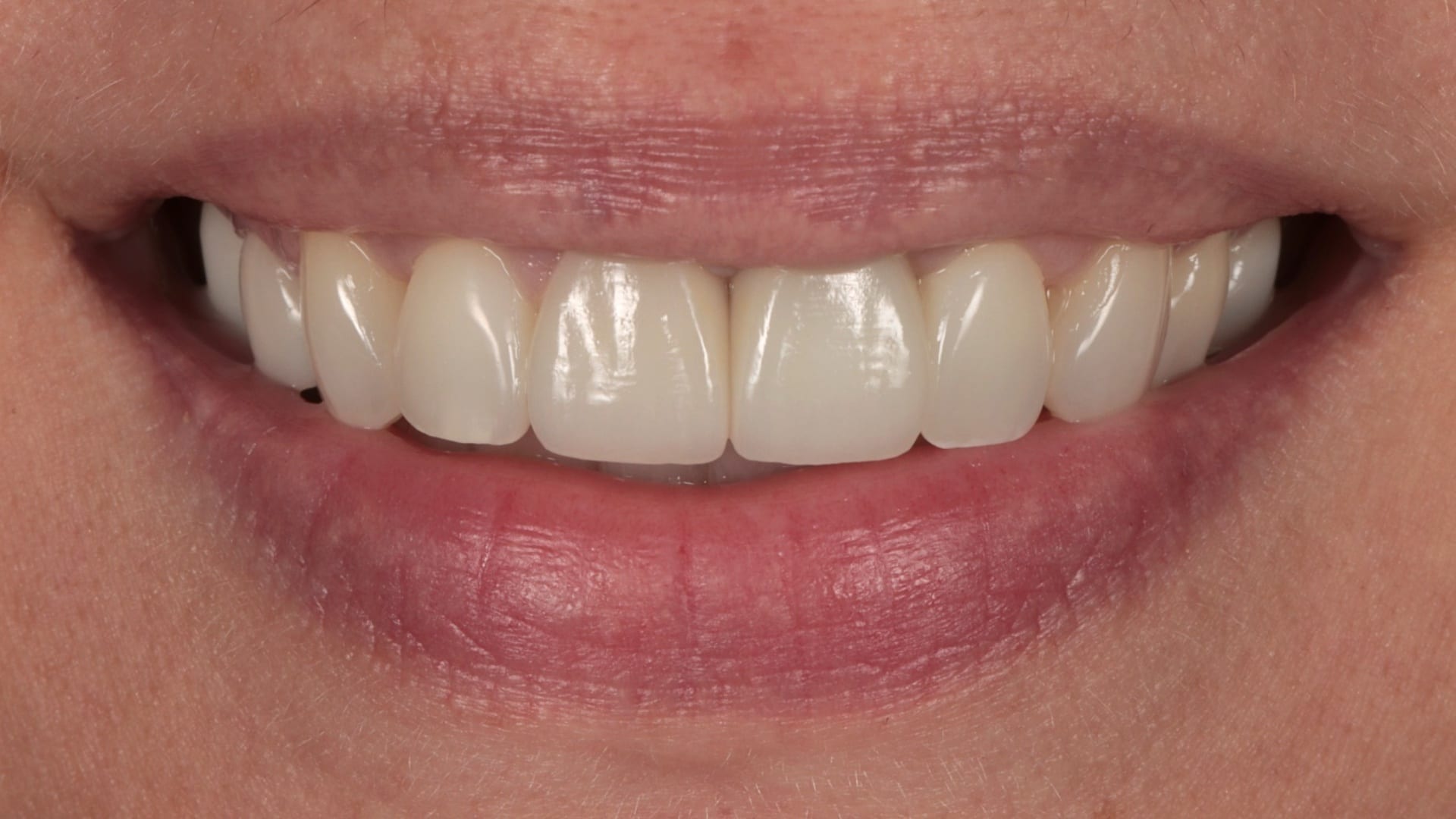 After — 2 porcelain crowns/veneers and 4x composite bonding