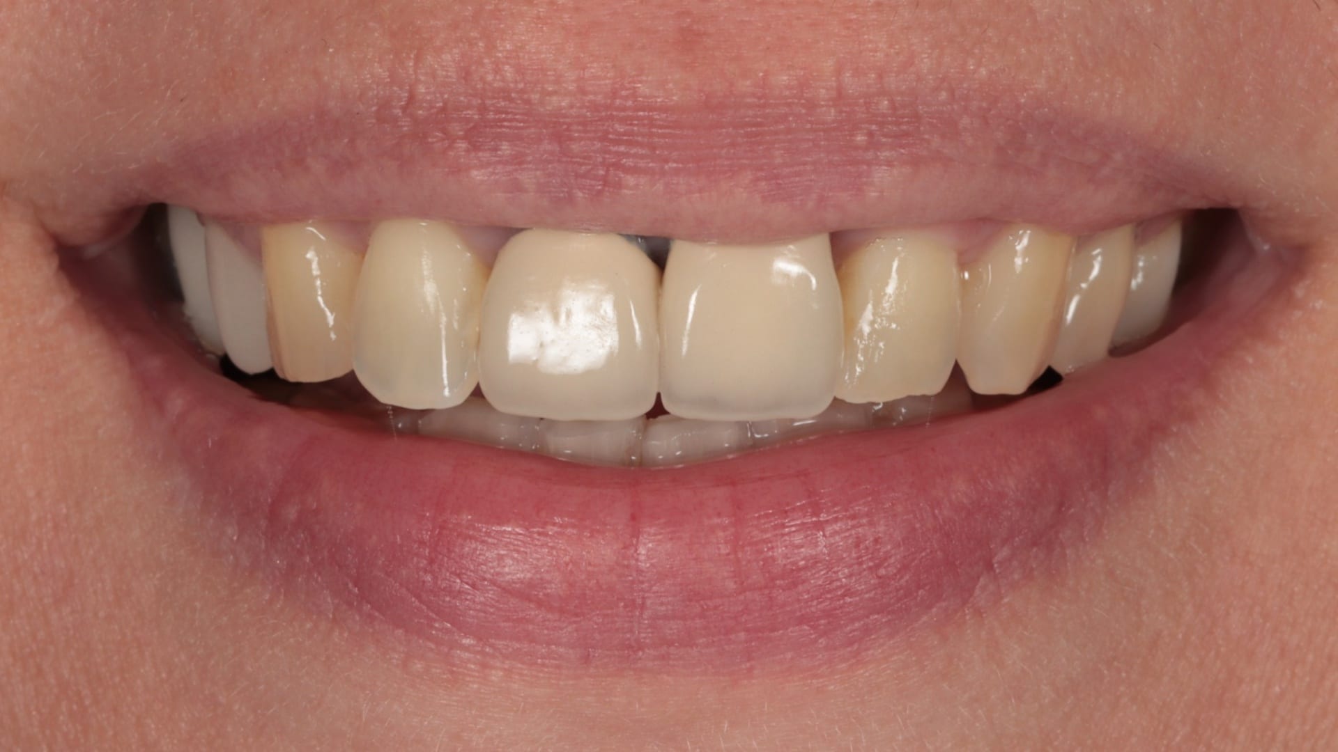 Before — 2 porcelain crowns/veneers and 4x composite bonding