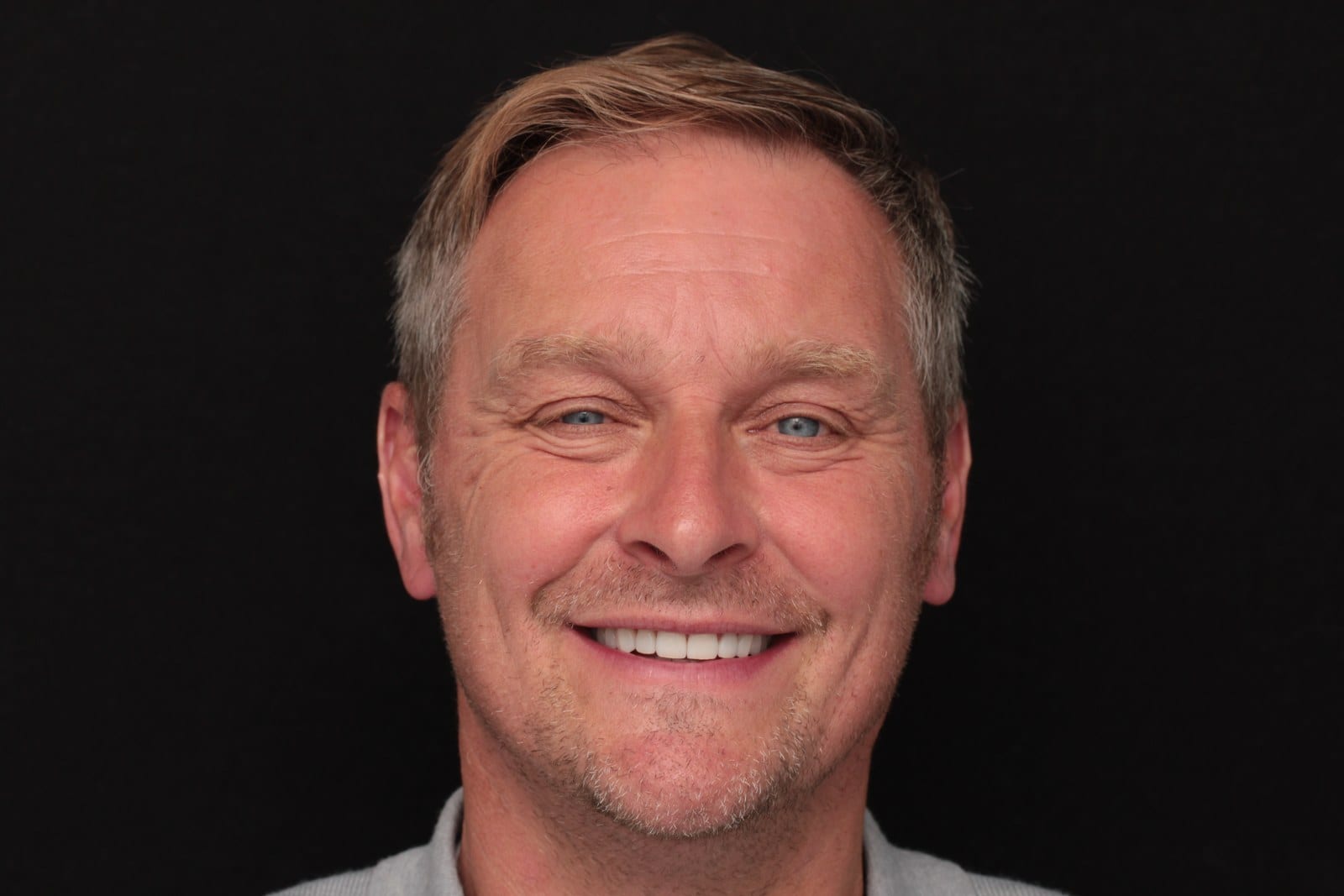 After — A complete smile rehabilitation in porcelain