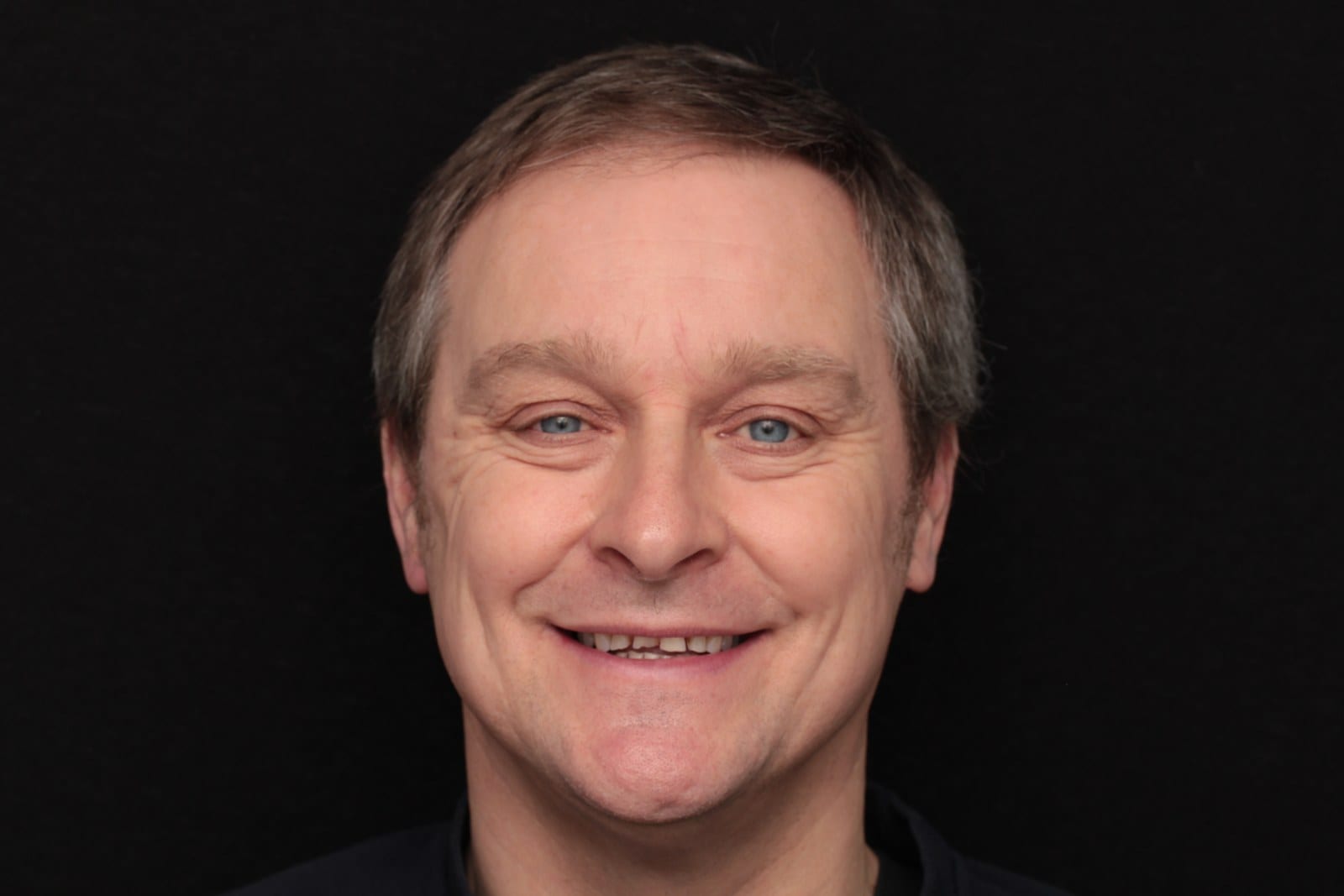 Before — A complete smile rehabilitation in porcelain