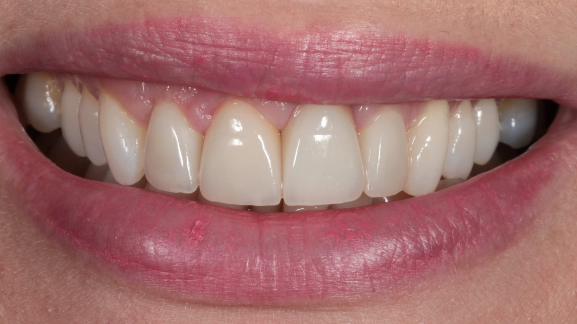 After — Old, discoloured veneers replaced — 4 porcelain veneers