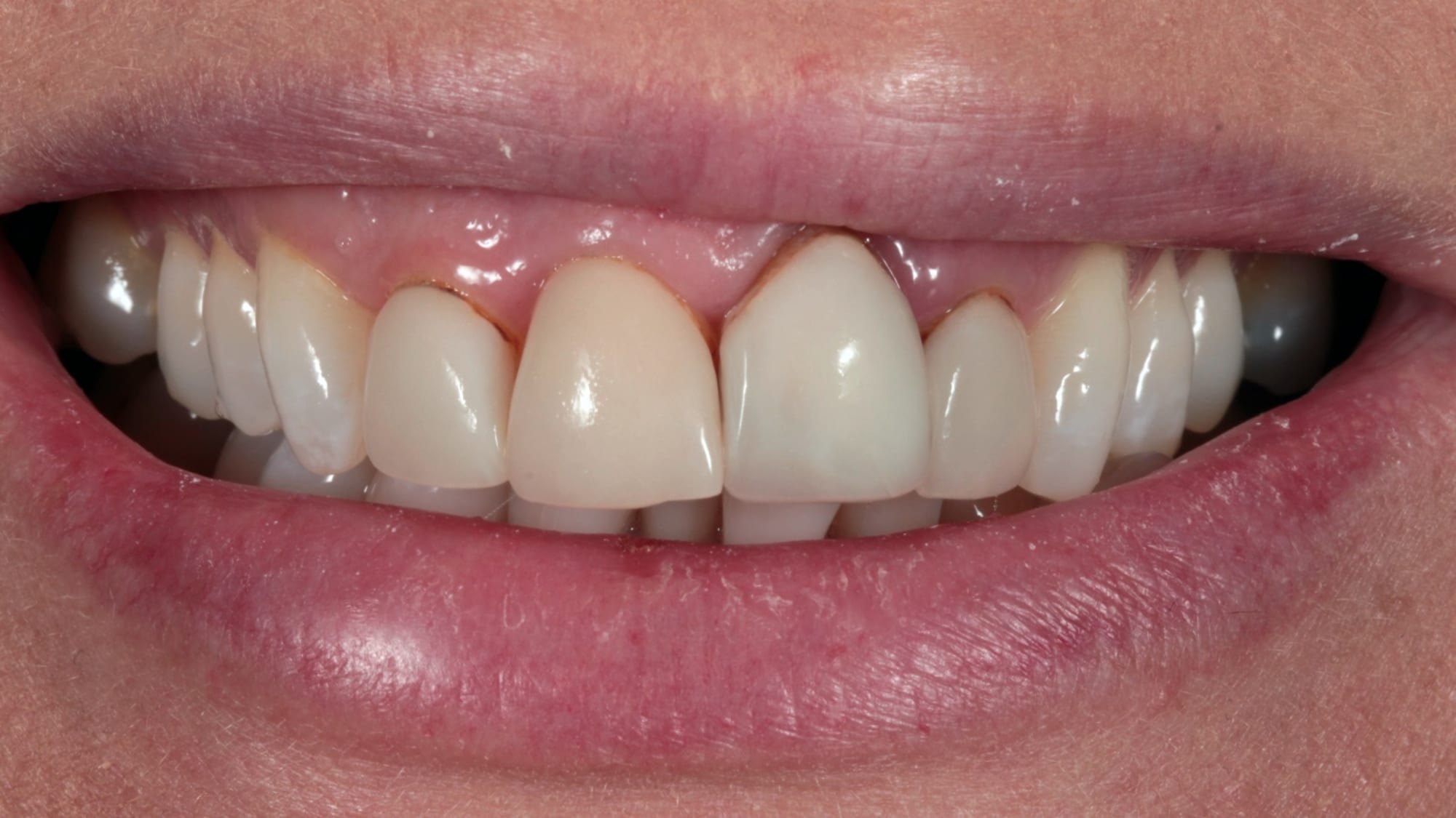 Before — Old, discoloured veneers replaced — 4 porcelain veneers