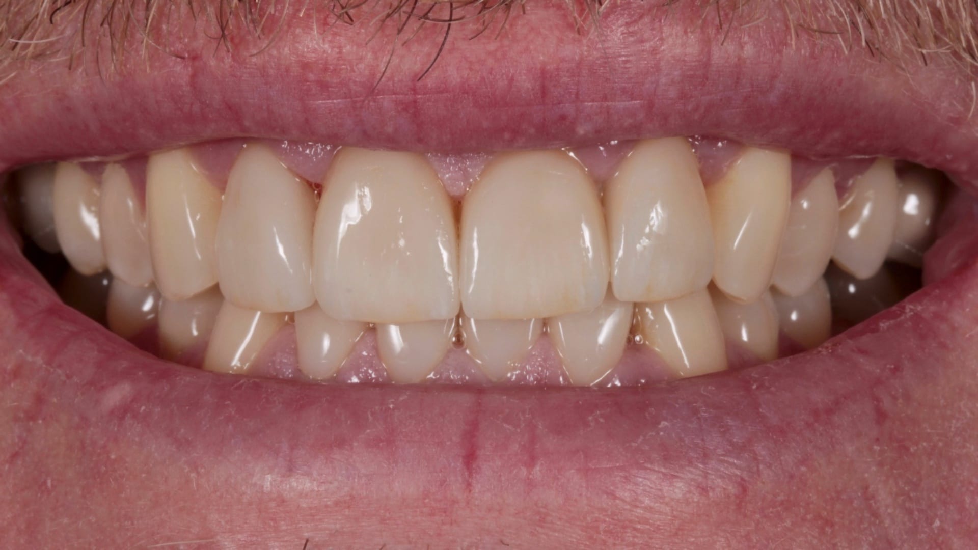 After — Porcelain veneers — natural and lifelike