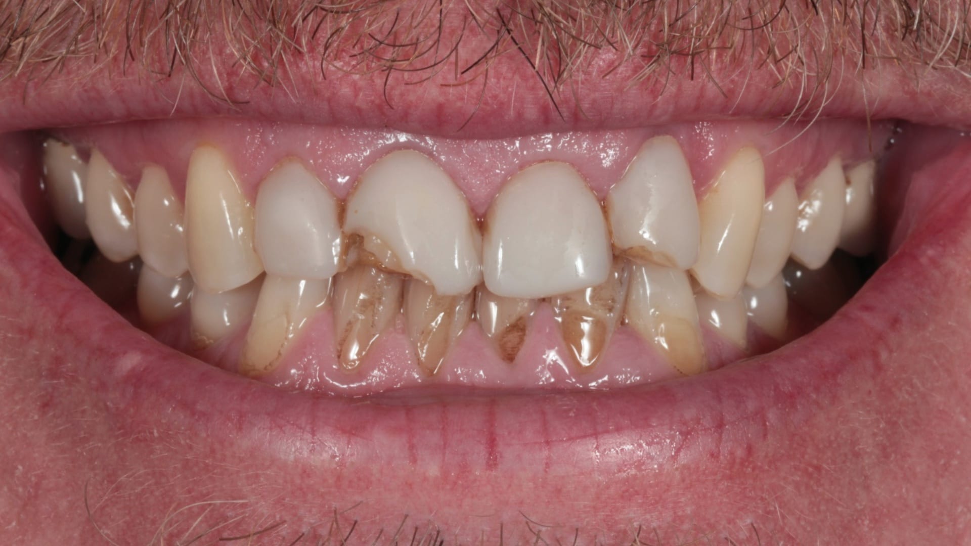 Before — Porcelain veneers — natural and lifelike