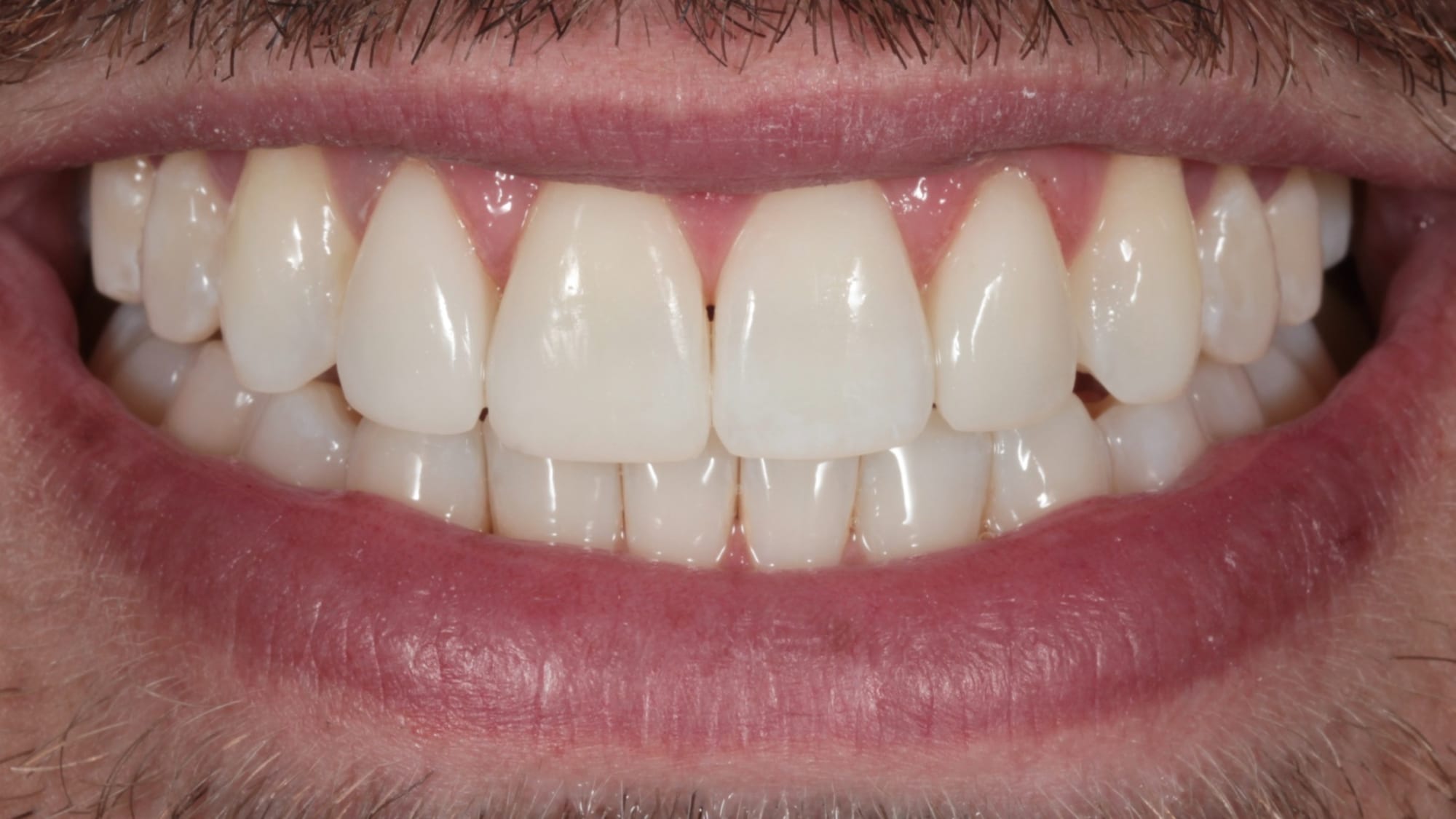 After — A gentle, natural brightening