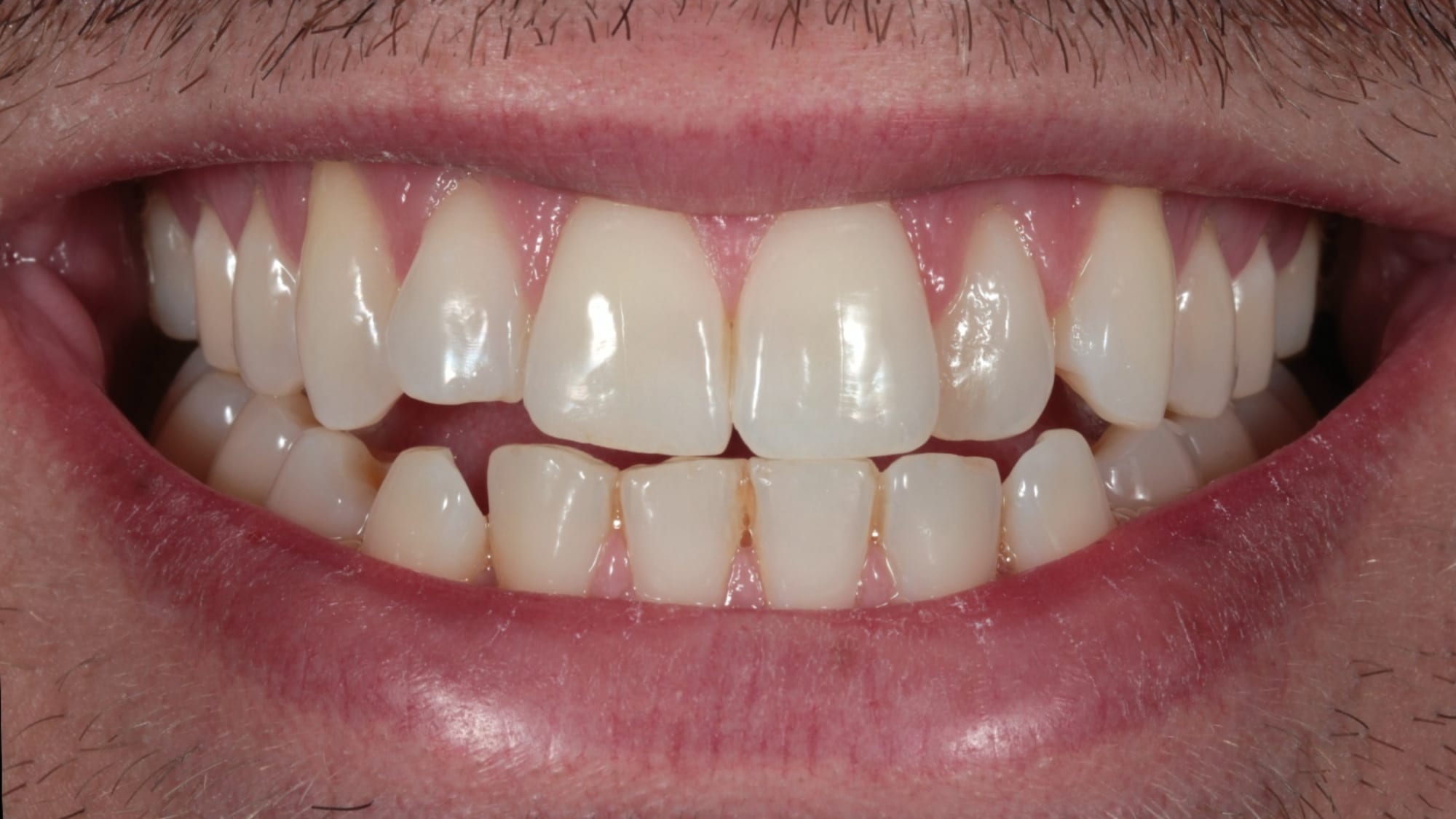 Before — A gentle, natural brightening