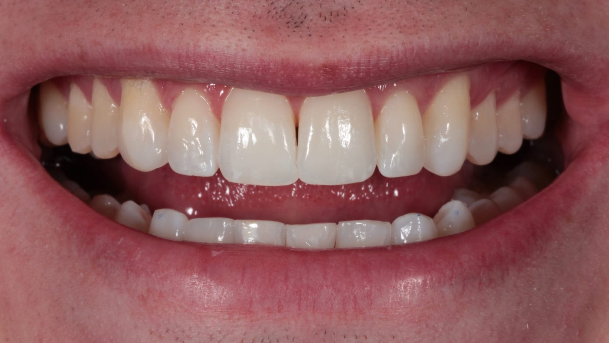 After — Home whitening — yellow staining lifted