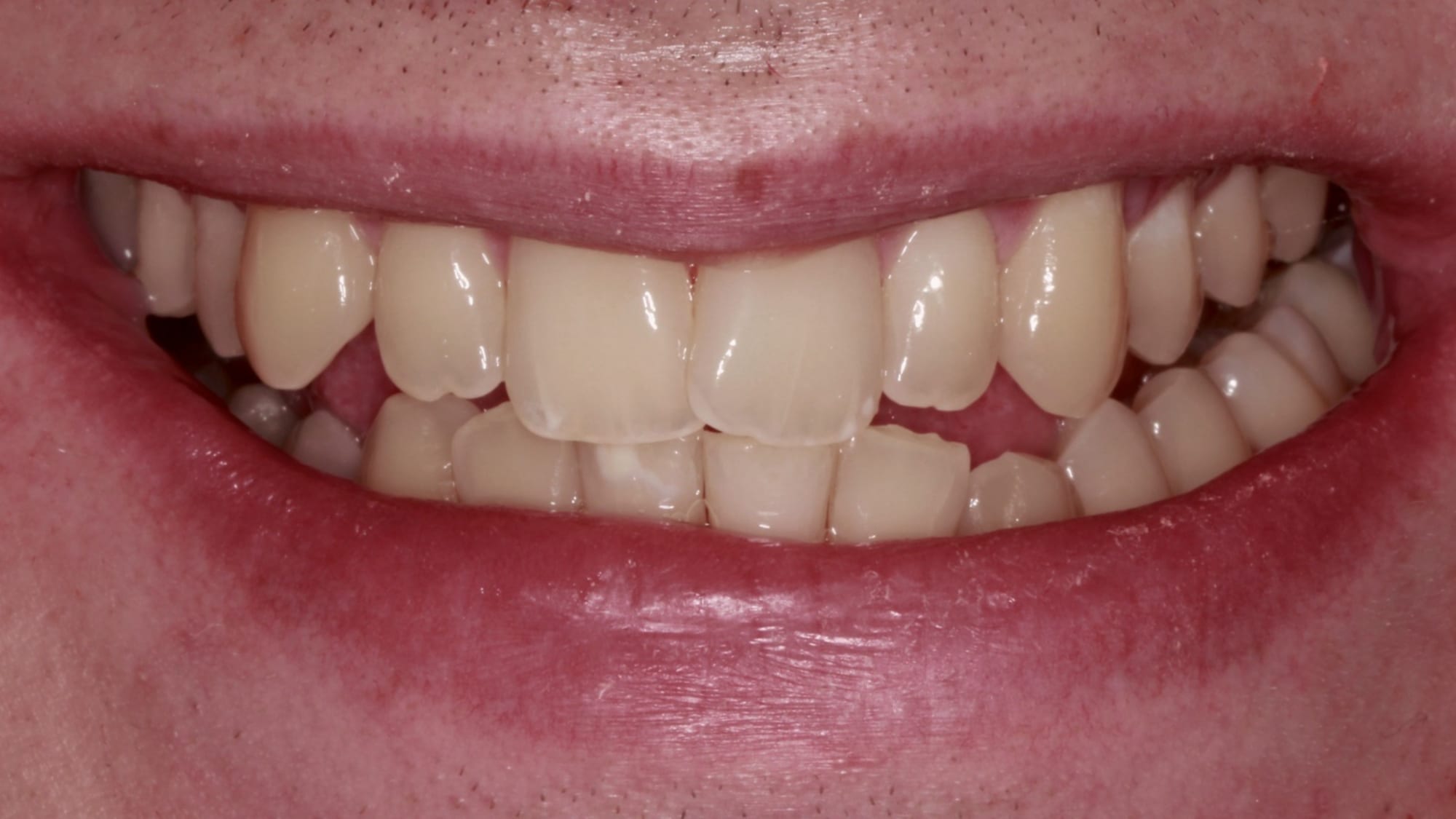 Before — Home whitening — yellow staining lifted