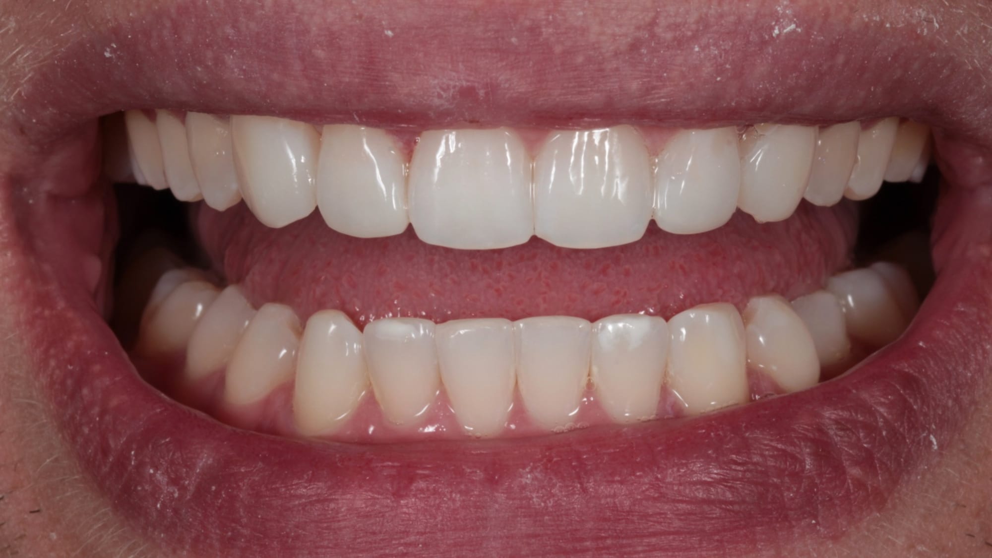 After — Professional home whitening with Invisalign — natural shade lift