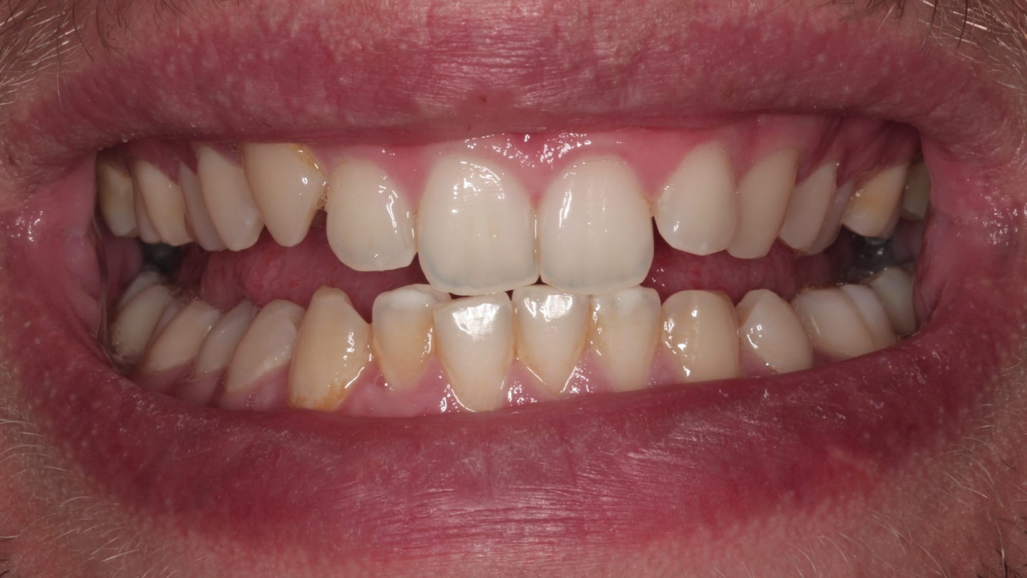 Before — Professional home whitening with Invisalign — natural shade lift